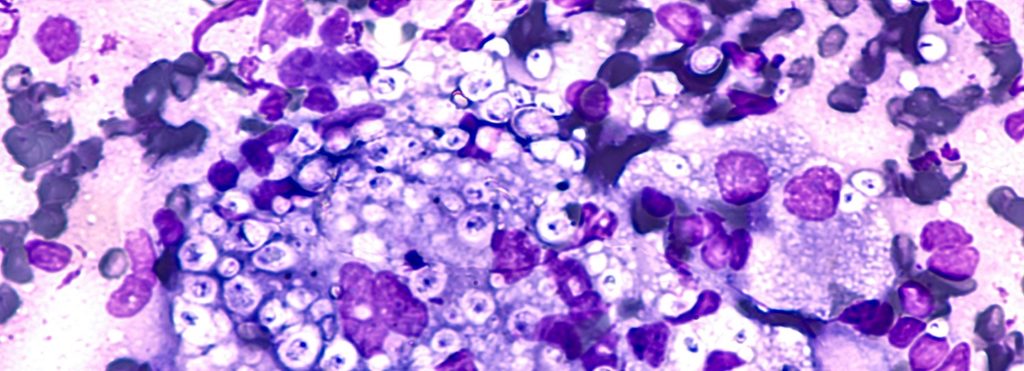 Safety Moments Histoplasmosis hero