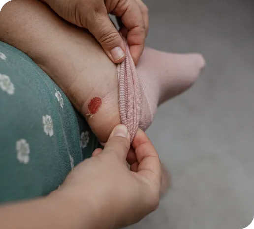 blisters-image.webp