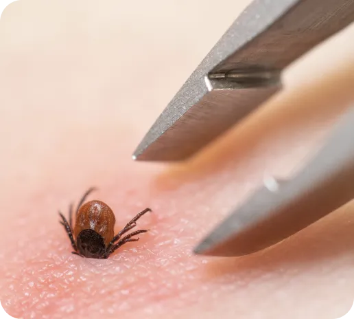 tick-bites-image.webp